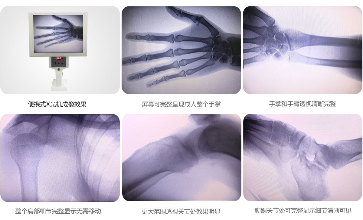 便携式X光机成像效果